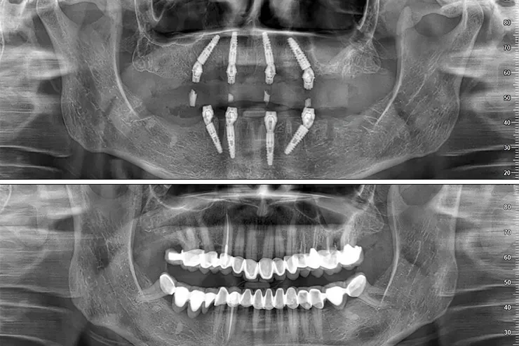 All on 4 İmplant at Key Smile