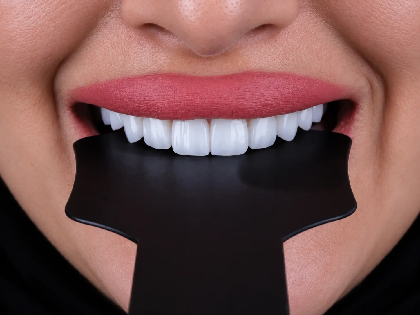 Lamina (Veneer) at Key Smile